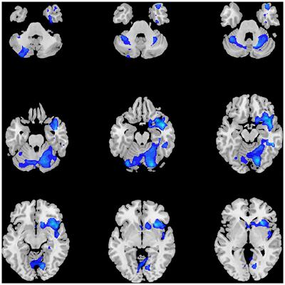 Volumetric Deficit Within the Fronto-Limbic-Striatal Circuit in First-Episode Drug Naïve Patients With Major Depression Disorder